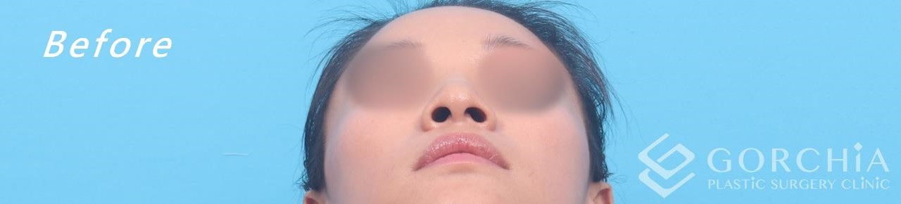 縮鼻翼/鼻孔手術-8