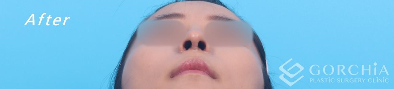 縮鼻翼/鼻孔手術-9
