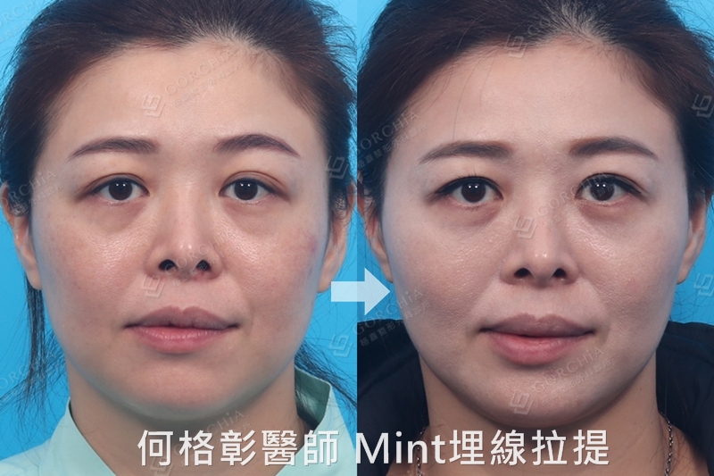 秘特線拉提（埋線拉提）-1