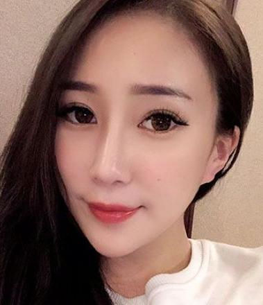 台中隆鼻推薦丨何格彰醫師成功案例