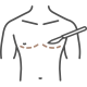 男性女乳手術