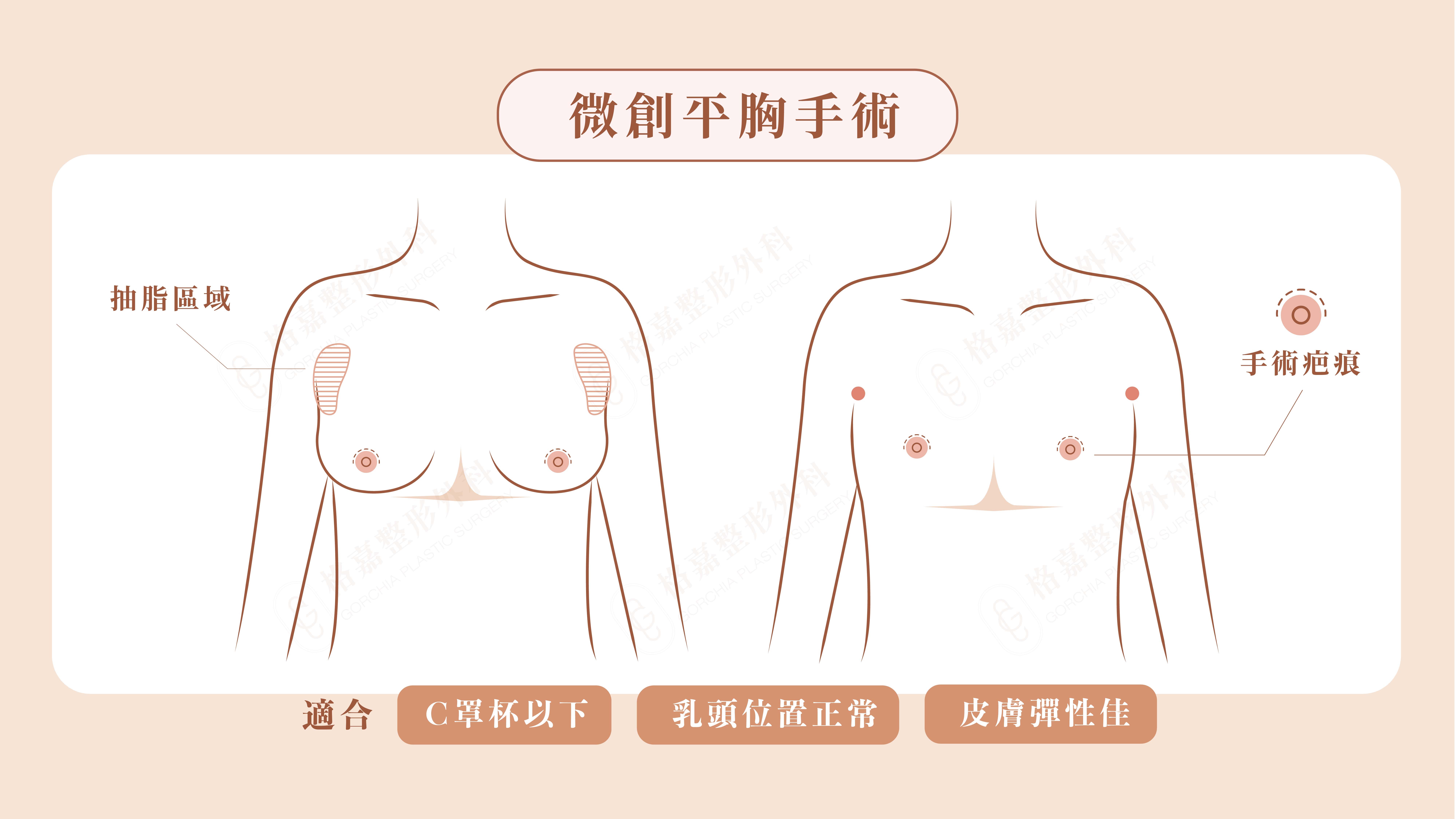 微創平胸