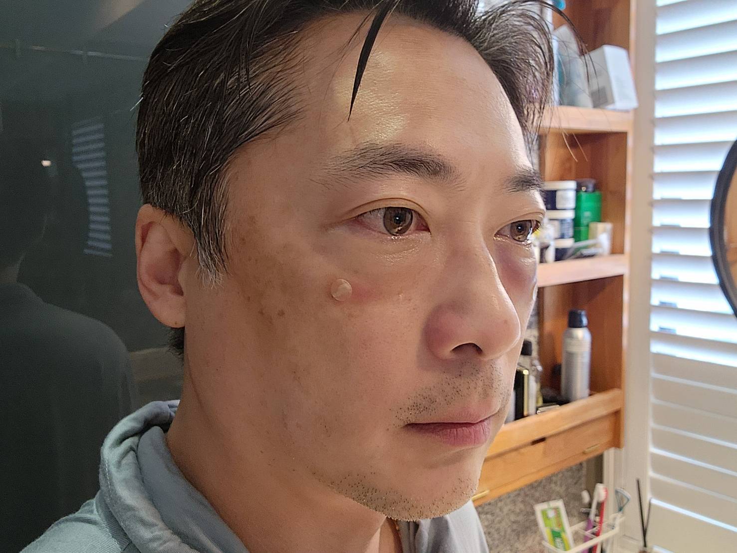 眼袋案例