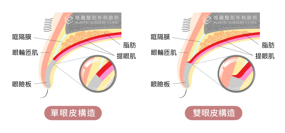 雙眼皮是如何形成?-單眼皮的構造