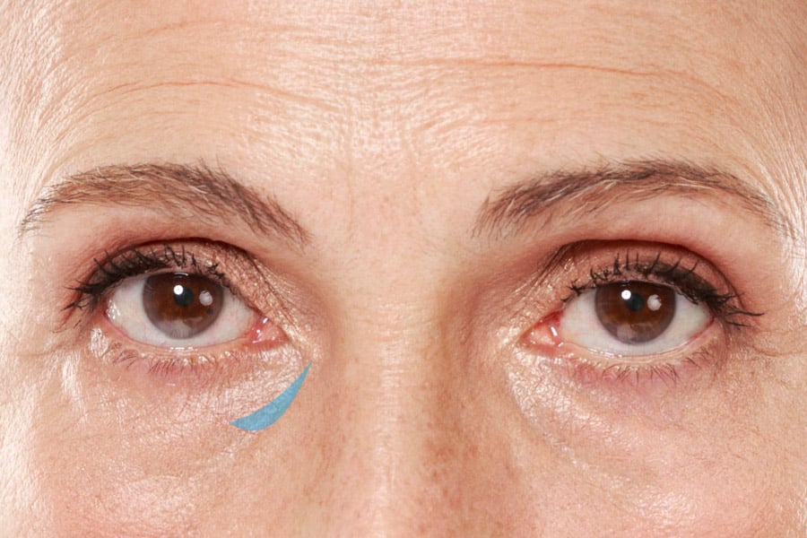 第一型的淚溝為集中於內側的凹陷，有些會延伸到臉頰的區塊