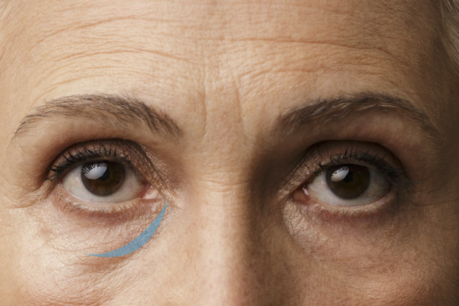 第二型的淚溝除了內側的凹陷，下眼眶的外側區塊也有凹陷，並且延伸到臉頰的中間區塊。