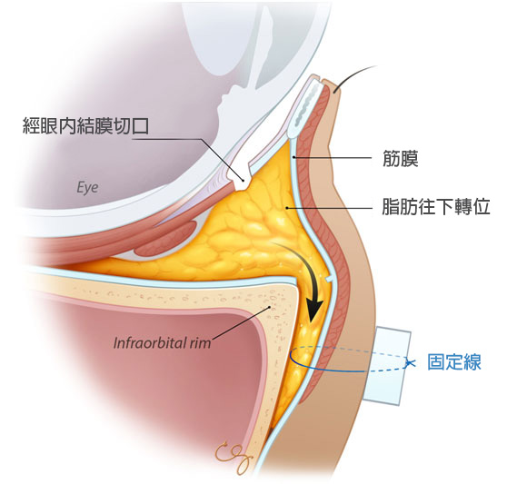 格嘉眼袋脂肪轉位手術－手術示意圖