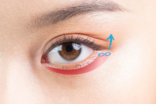 外眼角懸吊 ( lateral canthopexy ) 是眼袋手術當中非常重要的一環，