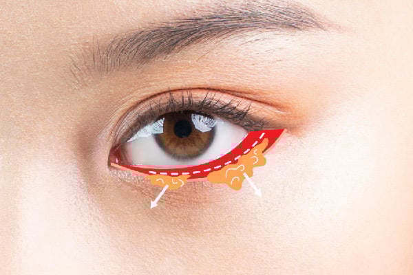 眼袋手術-眼袋脂肪處理(眼袋手術推薦_格嘉眼袋手術)