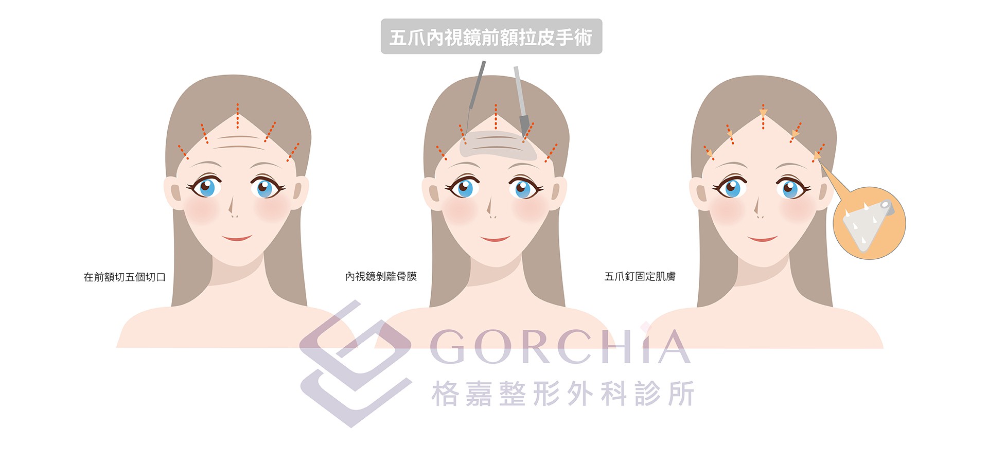 五爪內視鏡前額拉皮手術
