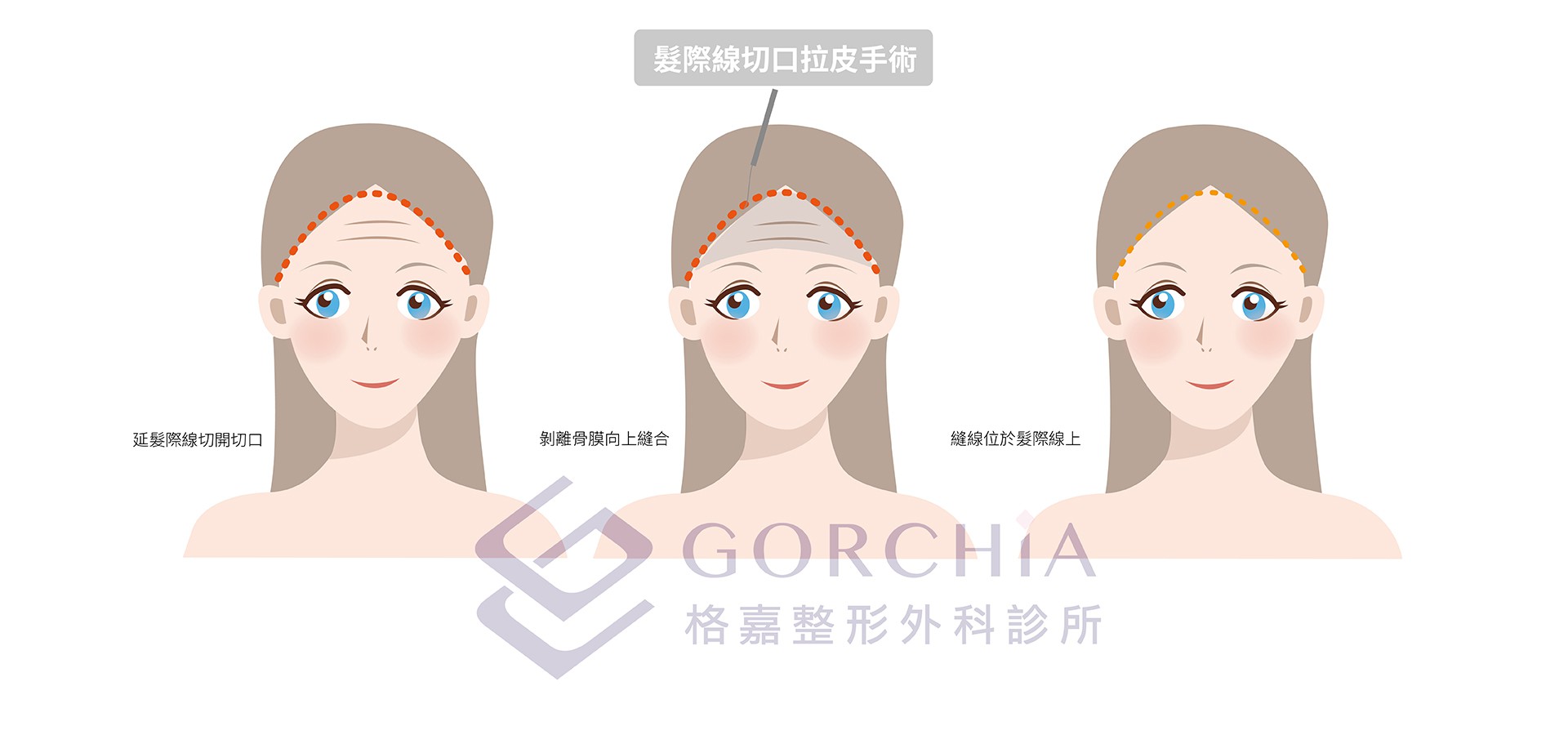 髮際線切口拉皮手術