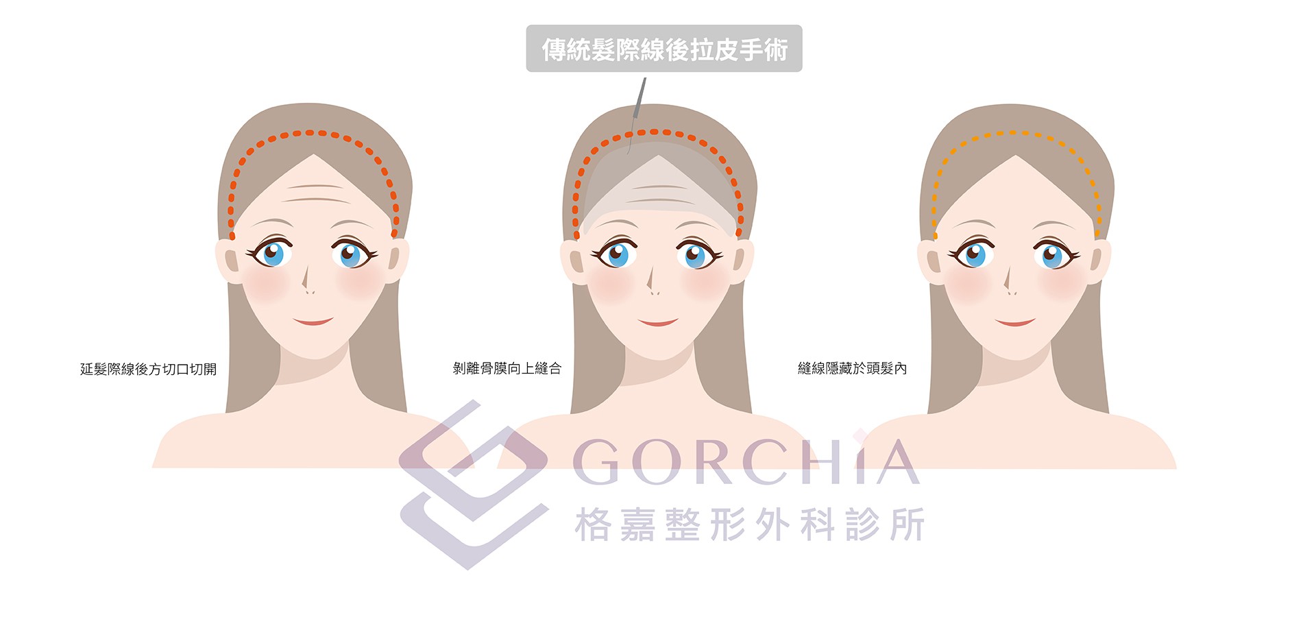 傳統髮際線後拉皮手術