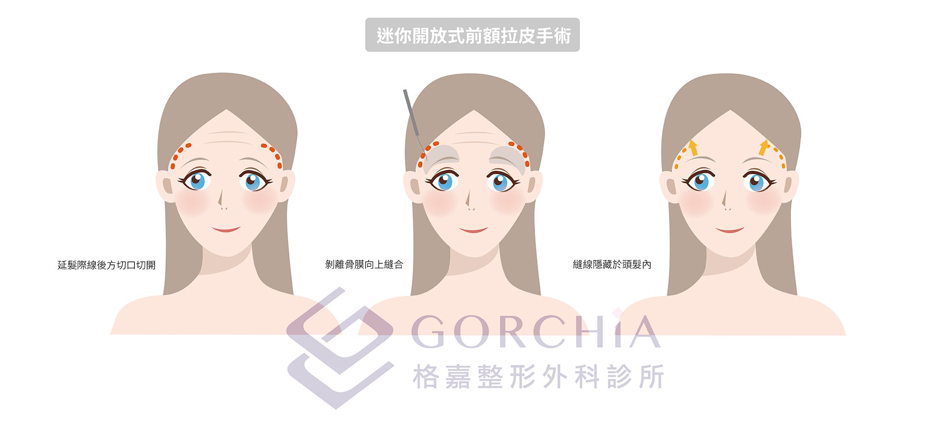 迷你開放式前額拉皮手術