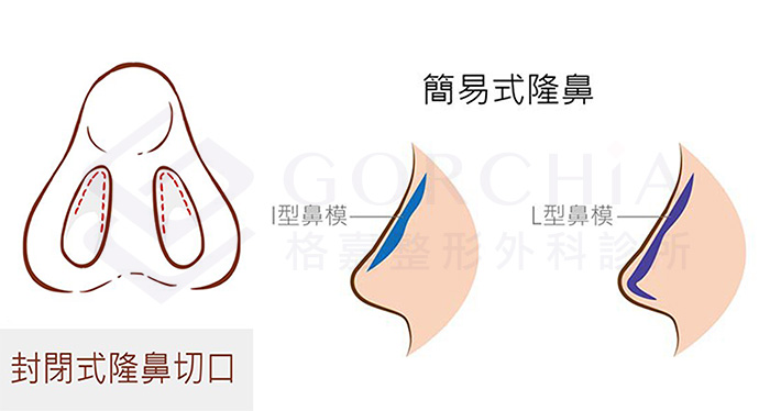 分段式隆鼻概念圖1|台中格嘉
