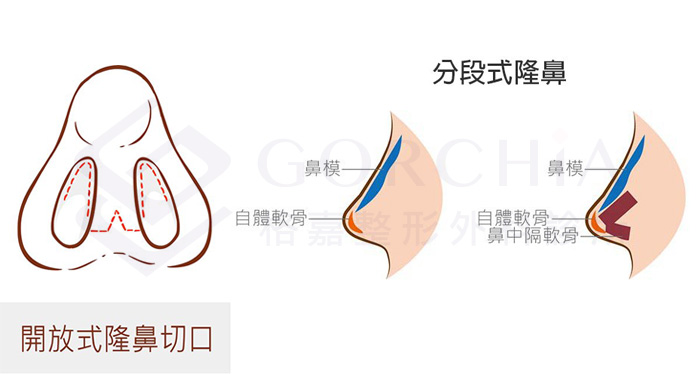 蒜頭鼻、朝天鼻、蓮霧鼻等鼻型條件較差者較適合做開放式隆鼻