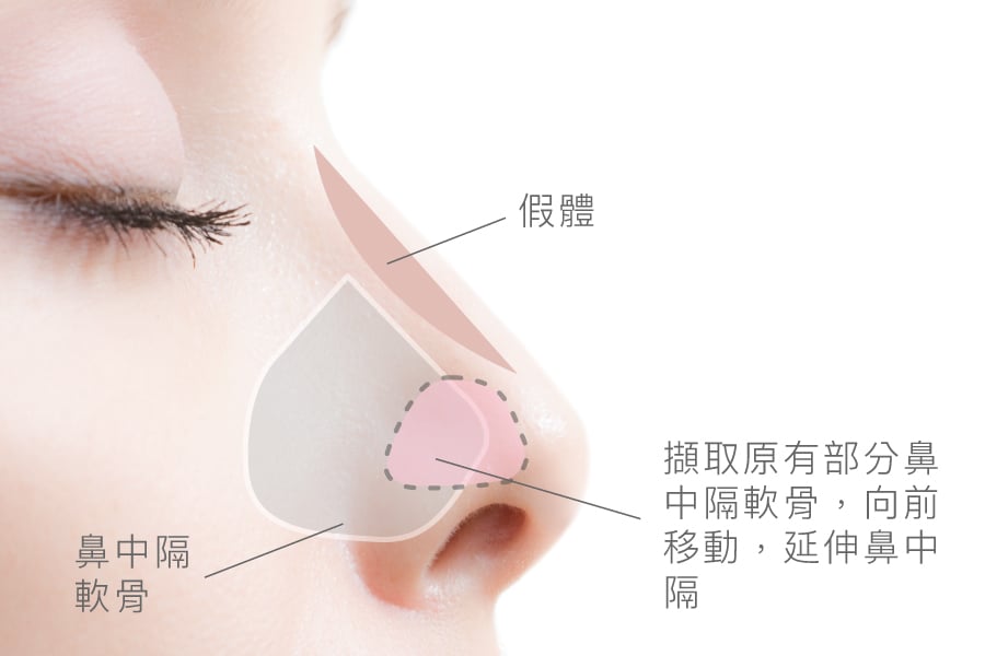 使用原有鼻中隔軟骨來延伸＿示意圖