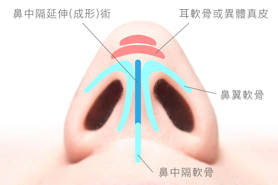 鼻中隔延長術後