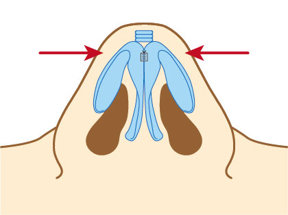 隆鼻手術或縮鼻翼手術