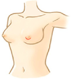 隆乳手術切口位置有哪些？乳暈上緣或下緣