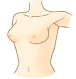 隆乳手術切口位置有哪些？腋下皺褶處