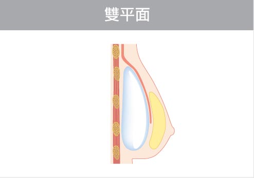 隆乳植入假體位置-雙平面