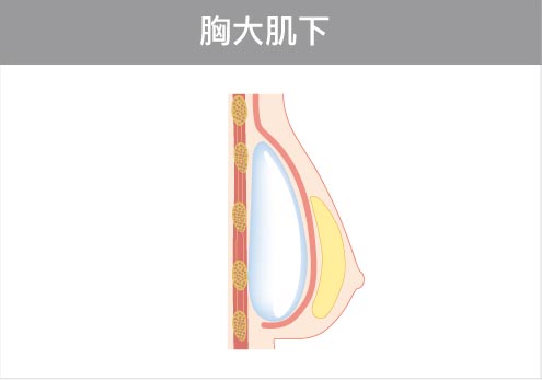 隆乳植入假體位置-胸大肌下