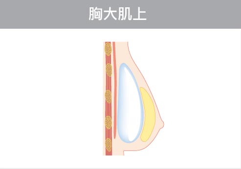 隆乳植入假體位置-胸大肌上