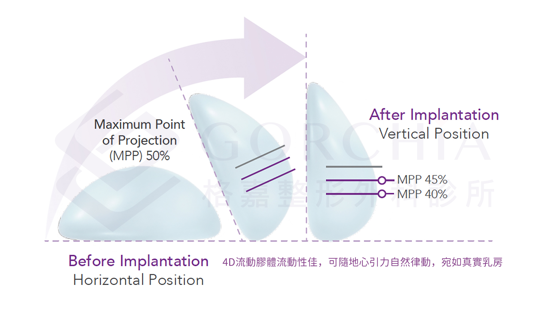 台中隆乳,隆乳,魔滴,女王波,柔滴