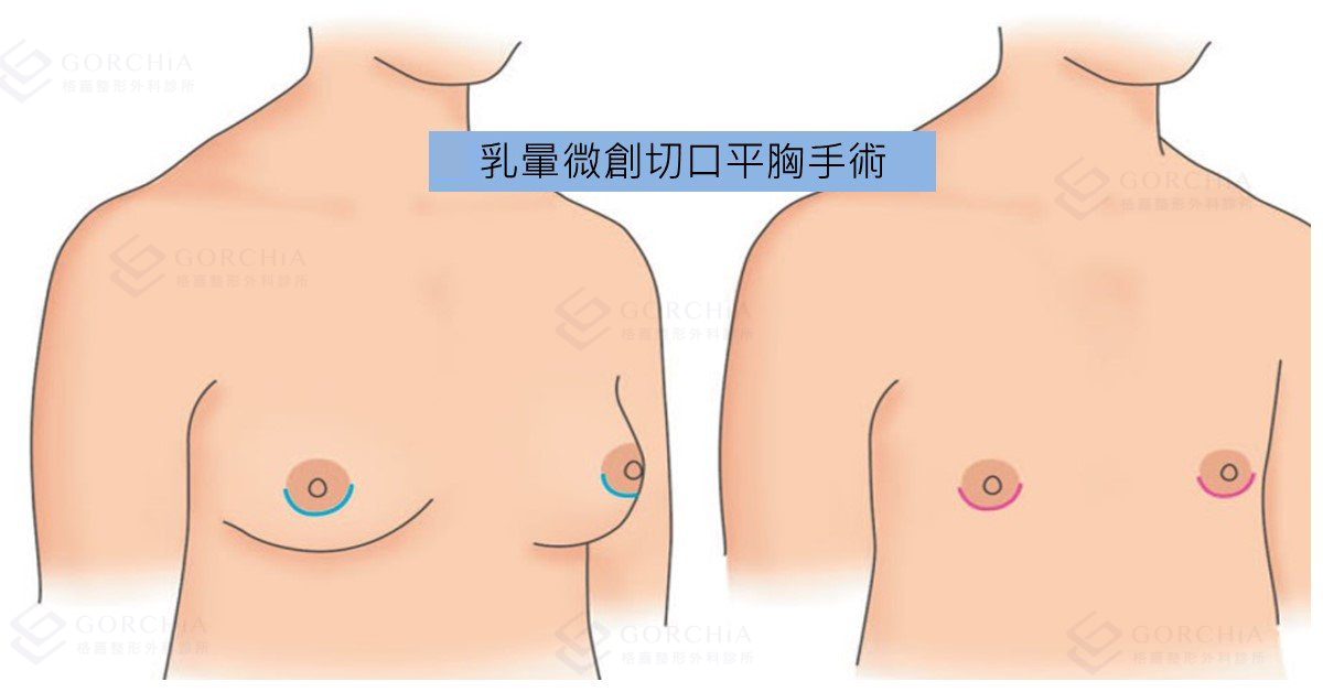 乳暈微創切口手術示意圖