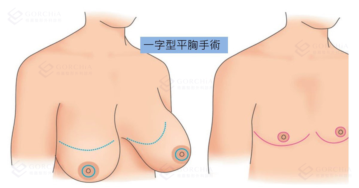 一字型平胸手術示意圖