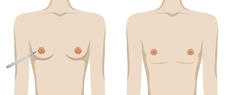 男性女乳症手術方式-純抽脂手術