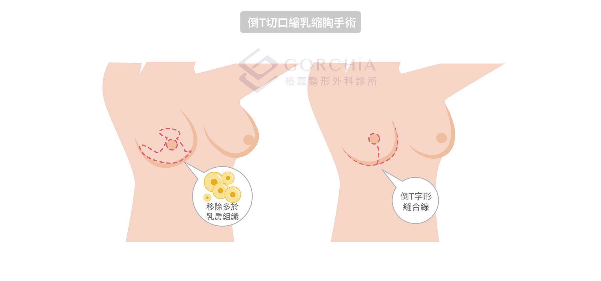 格嘉縮胸手術-倒T型切口縮乳縮胸手術