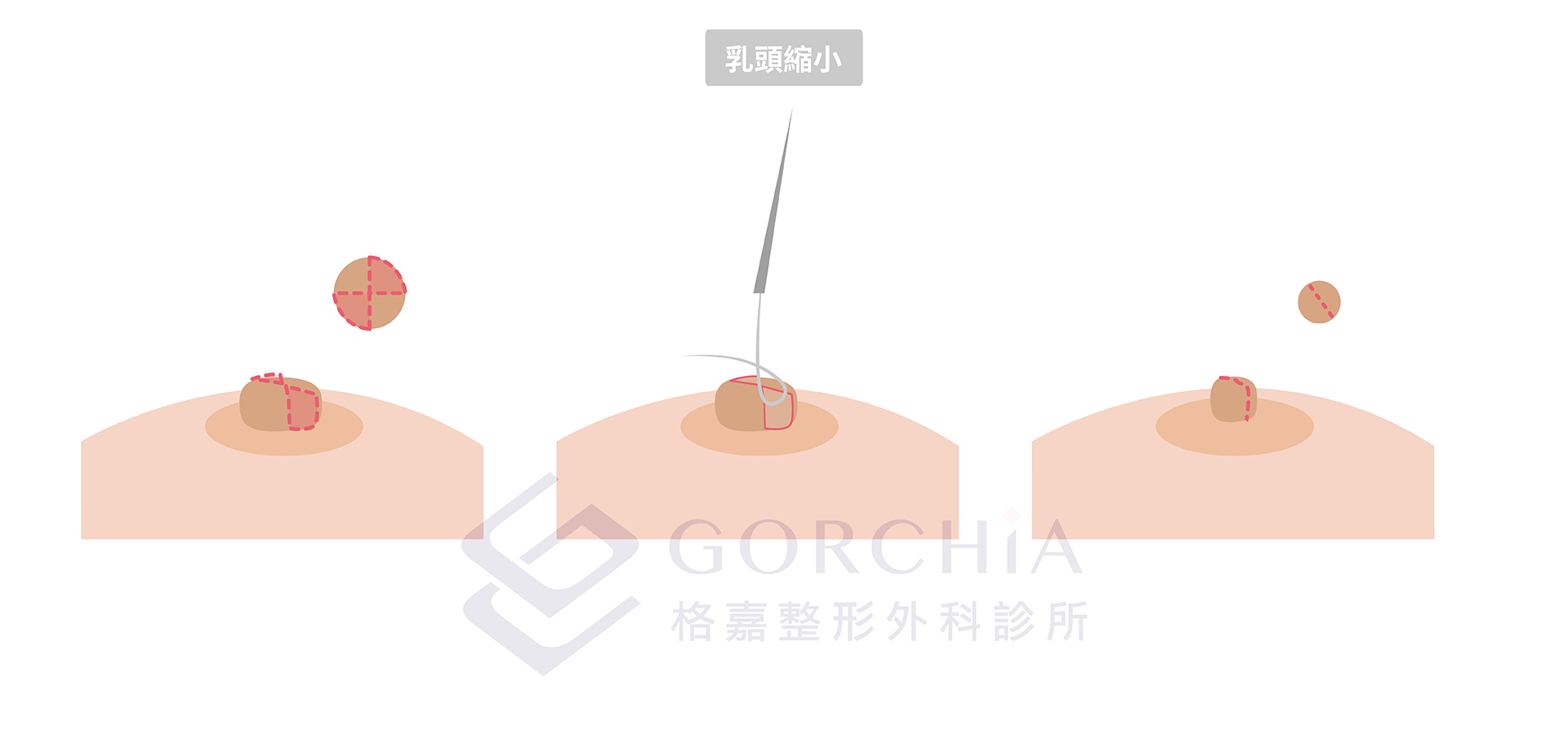 乳頭縮小