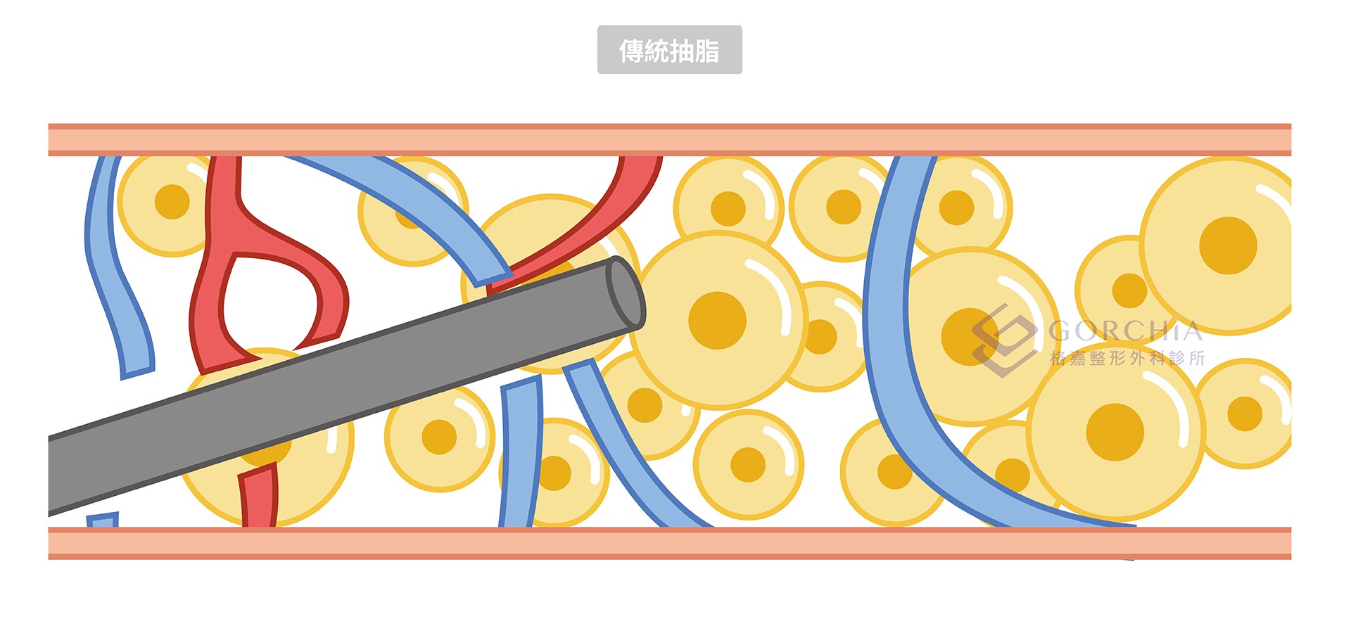 傳統抽脂 ( 負壓抽脂)