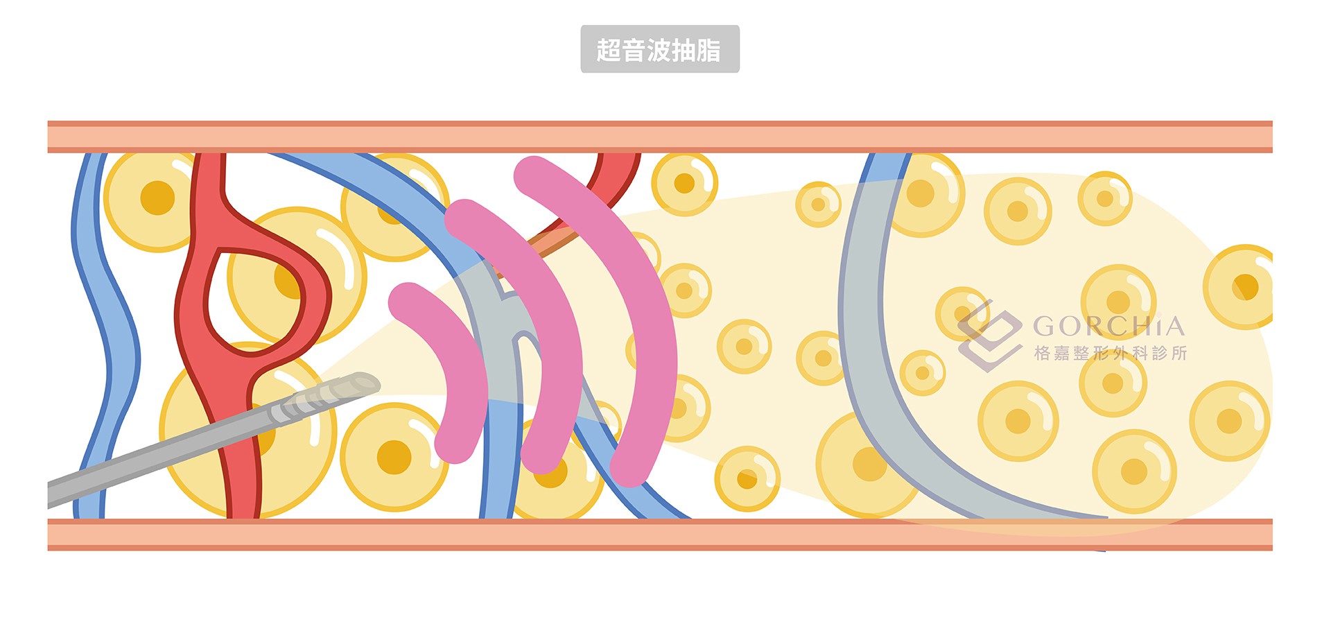 超音波抽脂