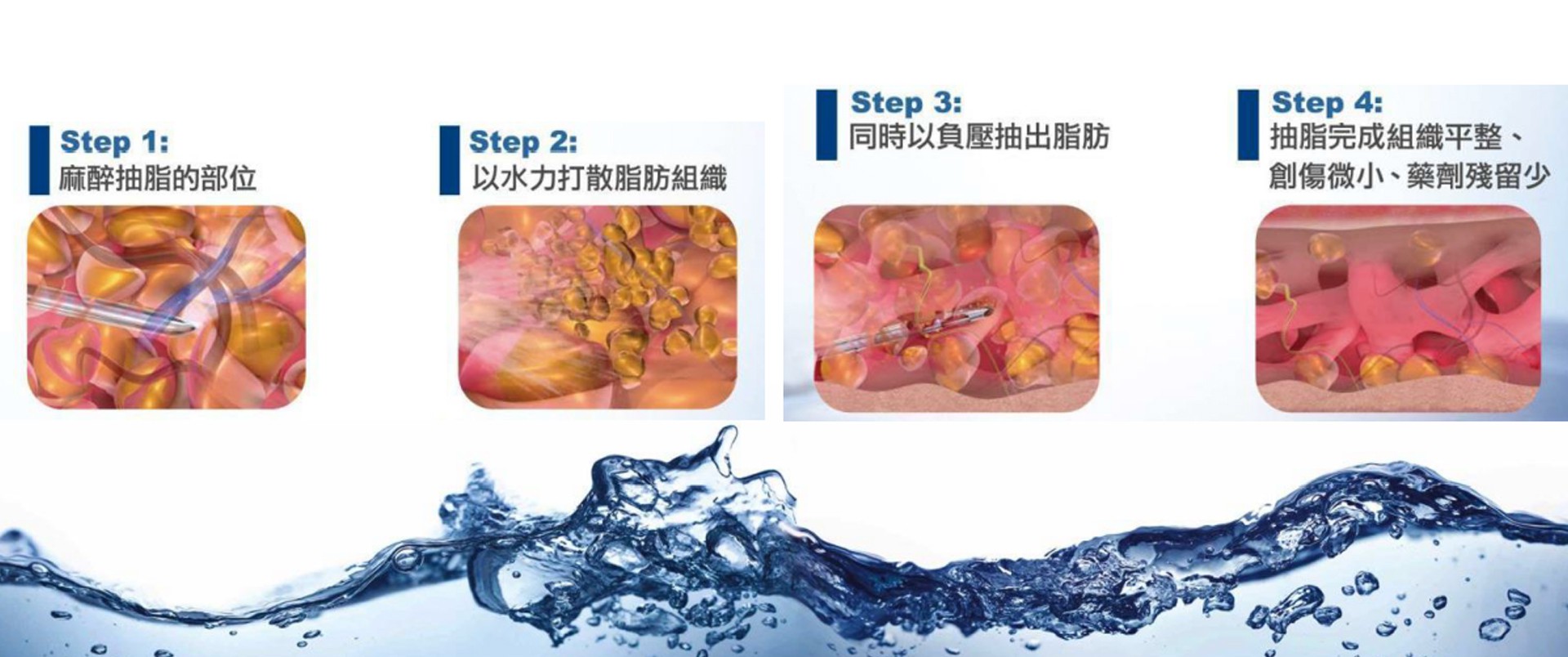 水刀抽脂步驟