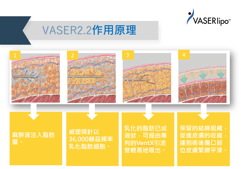 威塑vaser作用原理