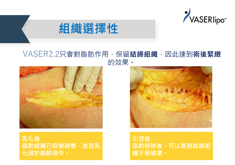 威塑vaser組織選擇性