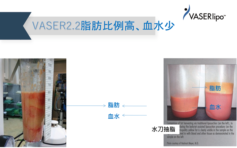 威塑抽脂血水比例