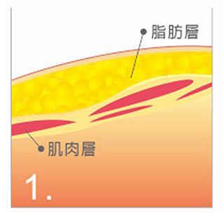 PAL 可進行深淺層脂肪抽取 (搭配抽脂管)