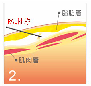 PAL 可進行深淺層脂肪抽取 (搭配抽脂管)