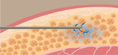 抽脂推薦-PAL(Power assisted liposution )動力抽脂系統