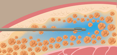 抽脂推薦-PAL(Power assisted liposution )動力抽脂系統