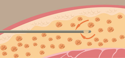 抽脂推薦-PAL(Power assisted liposution )動力抽脂系統