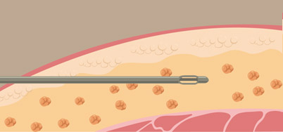 抽脂推薦-PAL(Power assisted liposution )動力抽脂系統