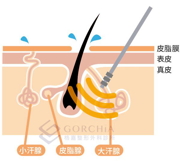 狐臭手術推薦,超音波狐臭手術