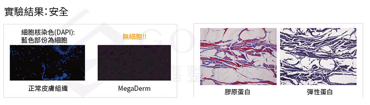 異體真皮,異體真皮法令紋,異體真皮是什麼