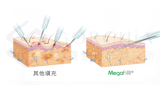 異體真皮,異體真皮法令紋,異體真皮是什麼