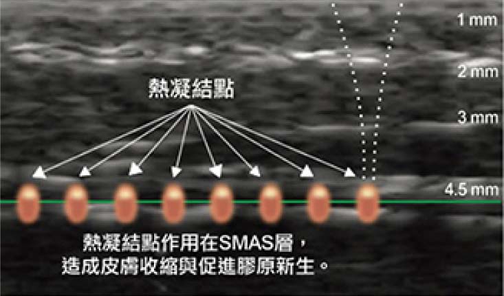 台中音波推薦,台中音波拉提,Ulthera 音波拉提