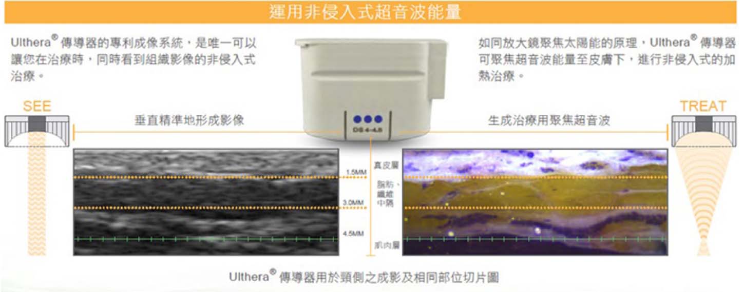 台中音波推薦,台中音波拉提,Ulthera 音波拉提